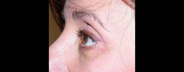 chirurgie-esthetique-interventions-paupieres-blépharoplasties