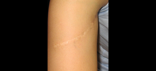 chirurgie-esthetique-interventions-cicatrices-grains-beauté-kystes-tatouages
