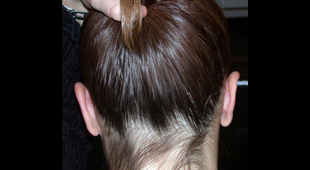 chirurgie-esthetique-pierre-nahon-interventions-oreilles-05