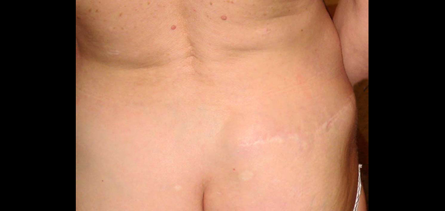 chirurgie-esthetique-interventions-cicatrices-grains-beauté-kystes-tatouages