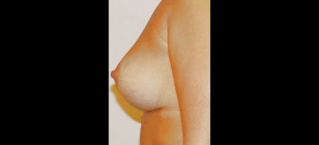 chirurgie-esthetique-interventions-seins-ptoses-mammaires-sans-implant