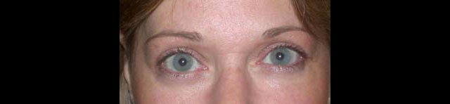 chirurgie-esthetique-interventions-paupieres-blépharoplasties