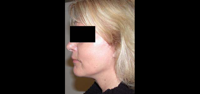 chirurgie-esthetique-interventions-visage-liftings