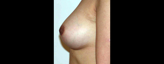 chirurgie-esthetique-interventions-seins-augmentations-mammaires