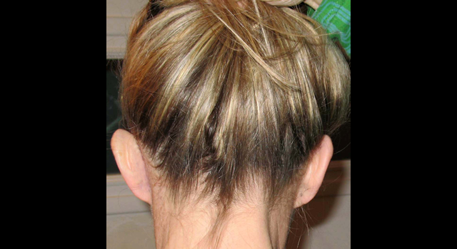 chirurgie-esthetique-pierre-nahon-interventions-oreilles-12
