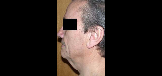 chirurgie-esthetique-interventions-visage-liftings