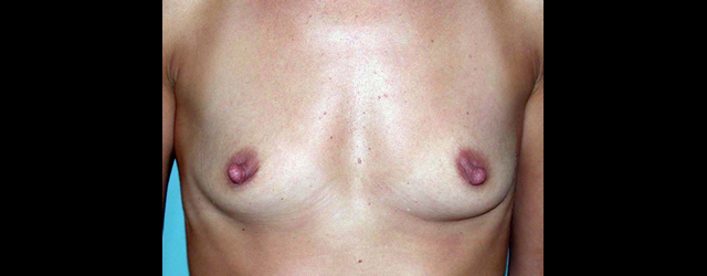 chirurgie-esthetique-interventions-seins-augmentations-mammaires