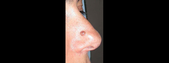 chirurgie-esthetique-interventions-cicatrices-grains-beauté-kystes-tatouages