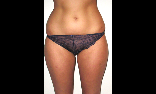 chirurgie-esthetique-interventions-lipoaspirations-liposuccions