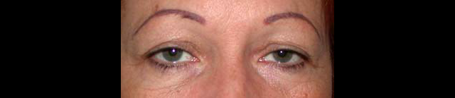 chirurgie-esthetique-interventions-paupieres-blépharoplasties