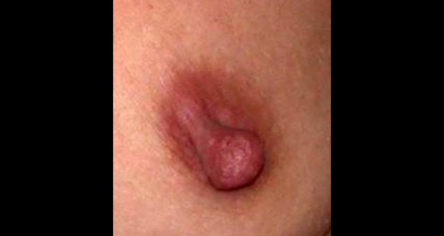 chirurgie-esthetique-interventions-seins-reduction-mamelon-00