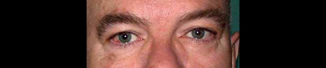 chirurgie-esthetique-interventions-paupieres-blépharoplasties