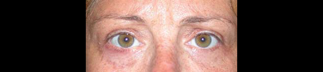 chirurgie-esthetique-interventions-paupieres-blépharoplasties