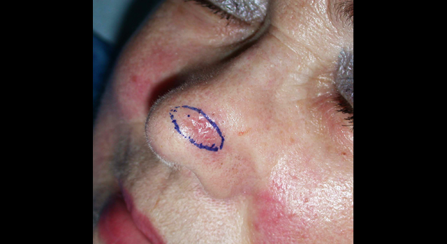 chirurgie-esthetique-cancer-cutane-nez