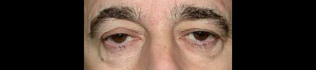 chirurgie-esthetique-interventions-paupieres-blépharoplasties