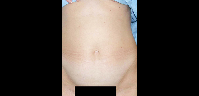 chirurgie-esthetique-interventions-abdomens-abdominoplasties