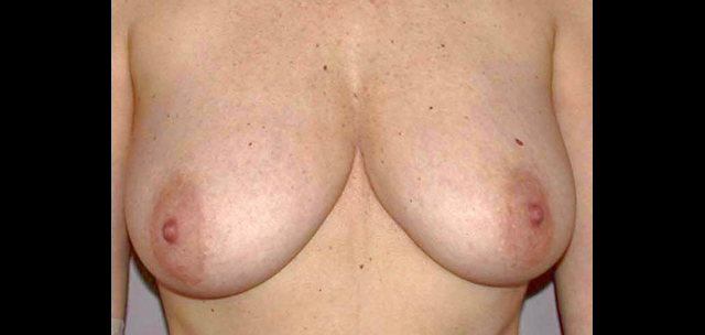 chirurgie-esthetique-interventions-seins-ptoses-mammaires-sans-implant