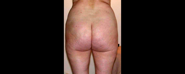 chirurgie-esthetique-interventions-lipoaspirations-liposuccions