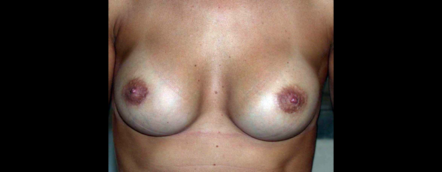 chirurgie-esthetique-interventions-seins-augmentations-mammaires