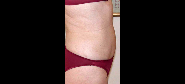 chirurgie-esthetique-interventions-lipoaspirations-liposuccions