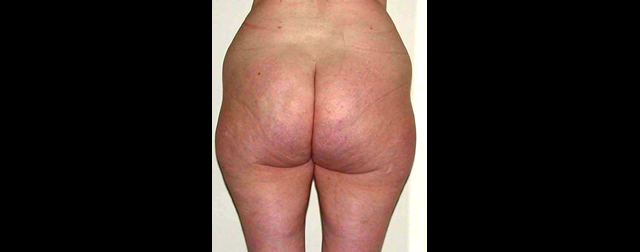 chirurgie-esthetique-interventions-lipoaspirations-liposuccions