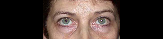 chirurgie-esthetique-interventions-paupieres-blépharoplasties