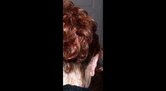 chirurgie-esthetique-pierre-nahon-interventions-oreilles-07