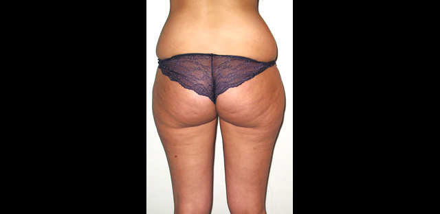 chirurgie-esthetique-interventions-lipoaspirations-liposuccions