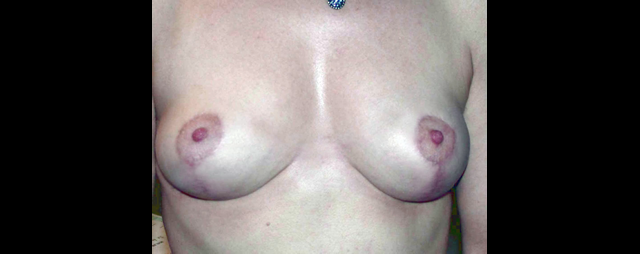 chirurgie-esthetique-interventions-seins-ptoses-mammaires-sans-implant