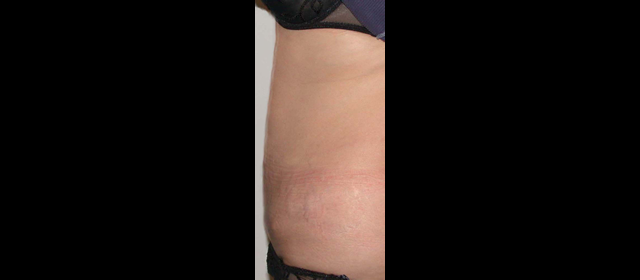 chirurgie-esthetique-interventions-abdomens-abdominoplasties