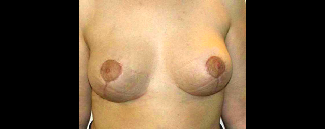 chirurgie-esthetique-interventions-seins-reductions-mammaires