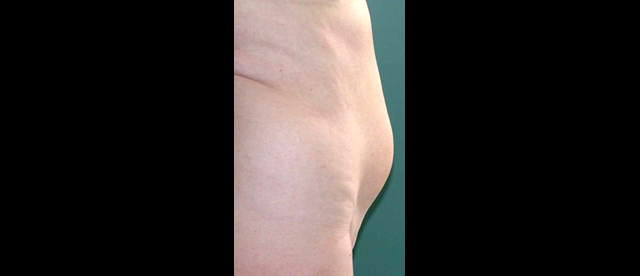chirurgie-esthetique-interventions-lipoaspirations-liposuccions