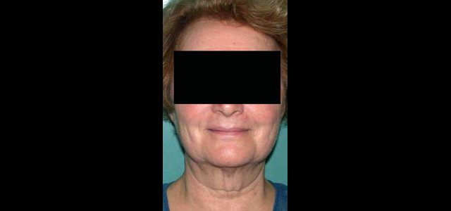 chirurgie-esthetique-interventions-visage-liftings
