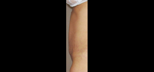 chirurgie-esthetique-interventions-abdomens-abdominoplasties