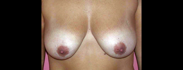 chirurgie-esthetique-interventions-seins-ptoses-mammaires-sans-implant