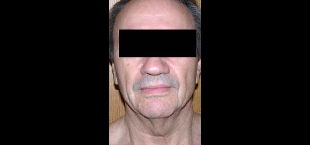 chirurgie-esthetique-interventions-visage-liftings