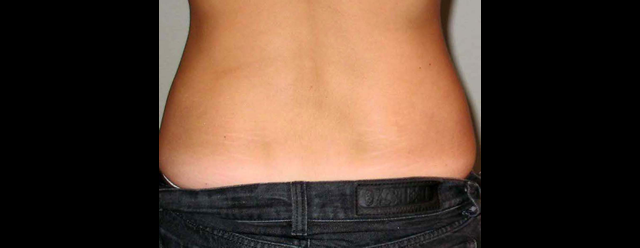 chirurgie-esthetique-interventions-lipoaspirations-liposuccions