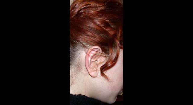 chirurgie-esthetique-pierre-nahon-interventions-oreilles-03