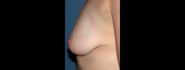 chirurgie-esthetique-interventions-seins-ptoses-mammaires-sans-implant