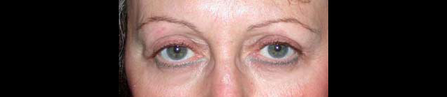 chirurgie-esthetique-interventions-paupieres-blépharoplasties