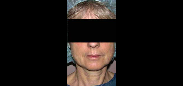 chirurgie-esthetique-interventions-visage-liftings