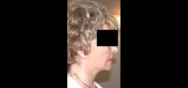 chirurgie-esthetique-interventions-visage-liftings