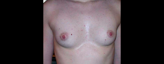 chirurgie-esthetique-interventions-seins-augmentations-mammaires