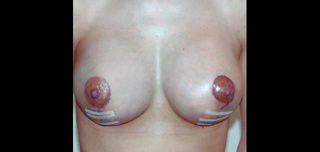 chirurgie-esthetique-interventions-seins-correction-ptose-avec-implants