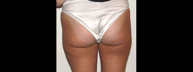 chirurgie-esthetique-interventions-lipoaspirations-liposuccions
