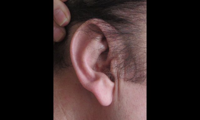 oreilles trop grandes
