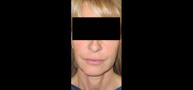 chirurgie-esthetique-interventions-visage-liftings