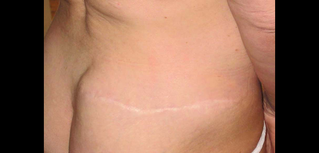 chirurgie-esthetique-interventions-cicatrices-grains-beauté-kystes-tatouages