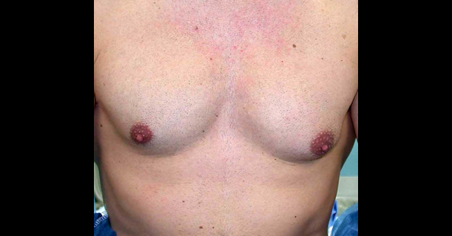 chirurgie-esthetique-interventions-gynecomasties