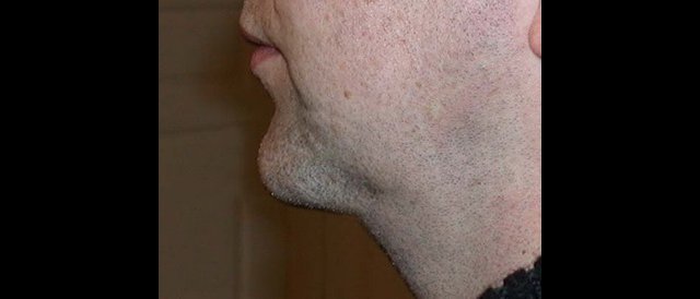 augmentation menton